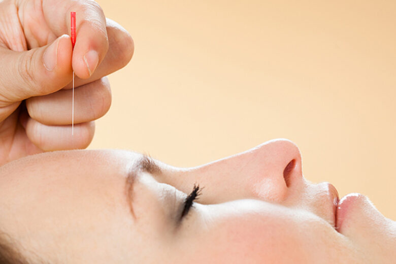 Co Je To Beauty Akupunktura? Trápí Vás Vrásky, Ale Odmítáte Botox?